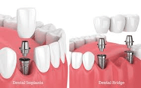 Dispelling Misconceptions about Dental Implants