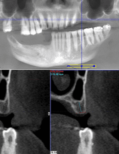 Bone Grafting 