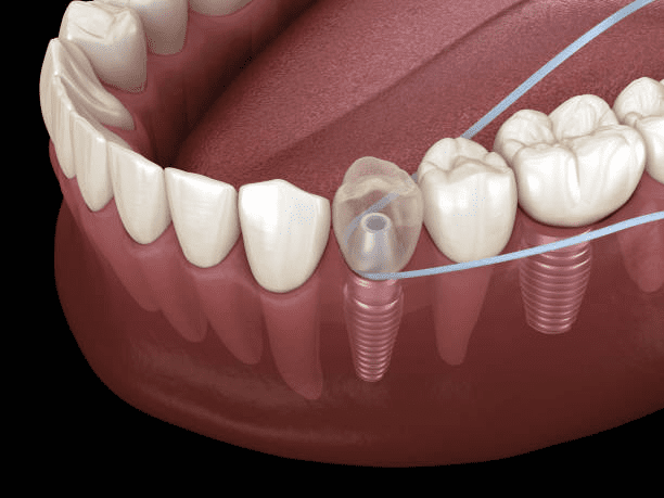 How to Properly Clean and Maintain Your Dental Implants