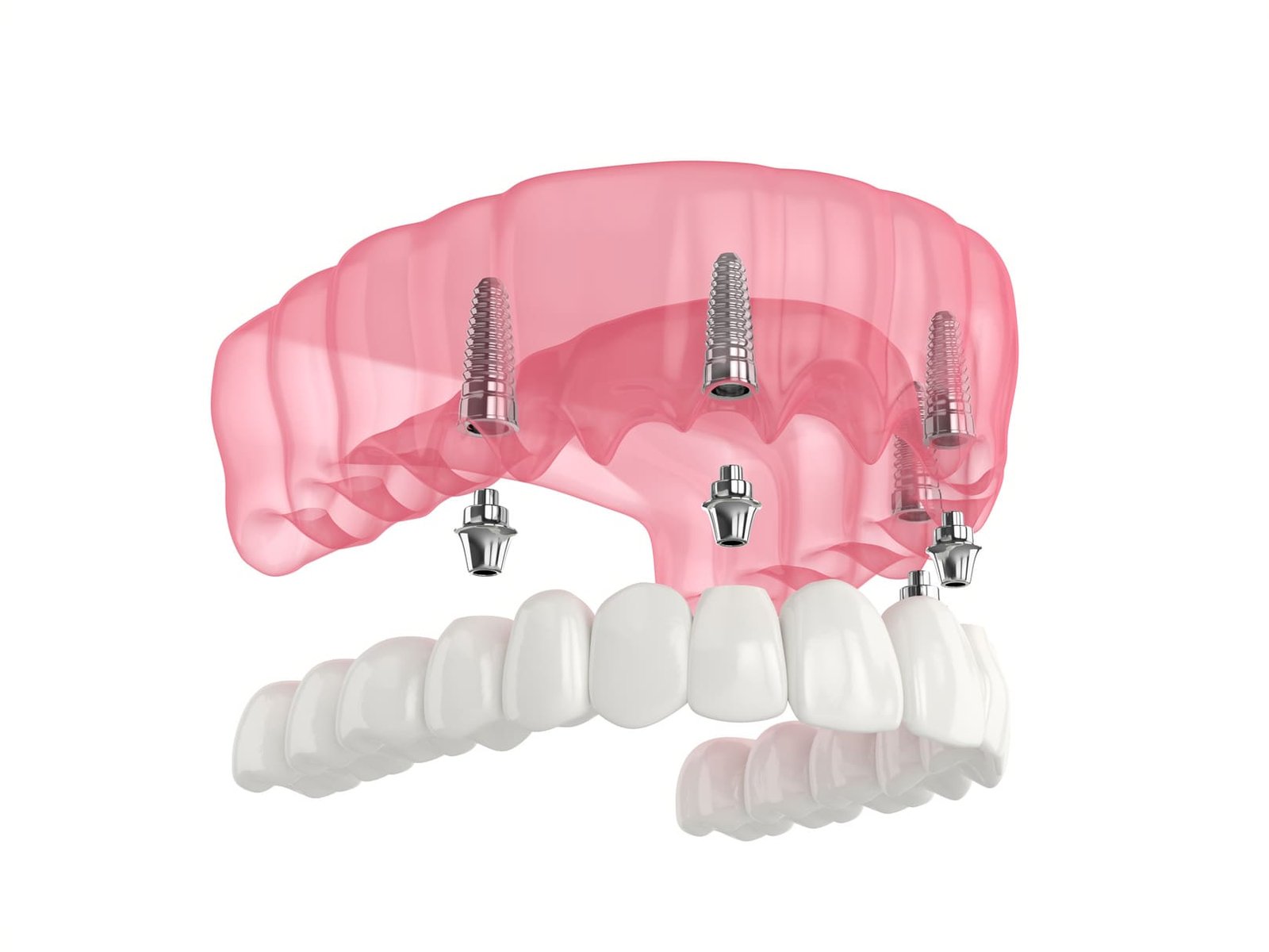 Why All on Four Dental Implants Are a Great Choice for Topeka Residents