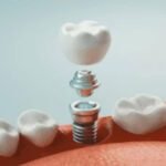 5 Interesting Facts About Dental Implants - Topeka Oral Surgery