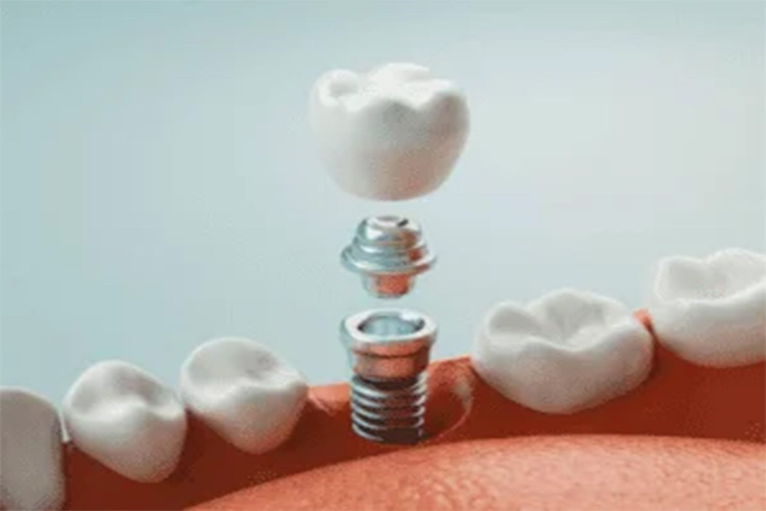 5 Interesting Facts About Dental Implants – Topeka Oral Surgery