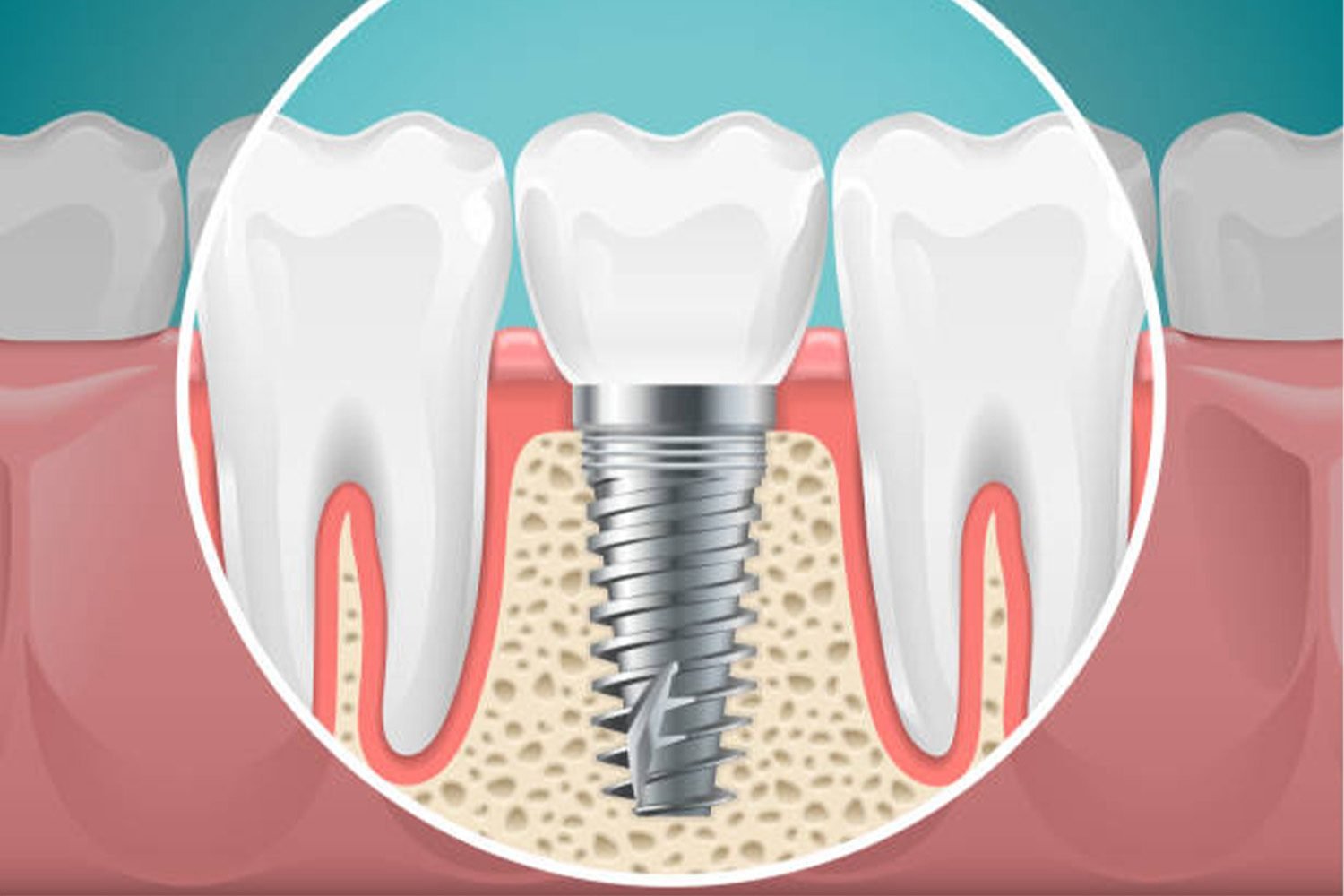 How Do Dental Implants Fuse with Bone Tissue?