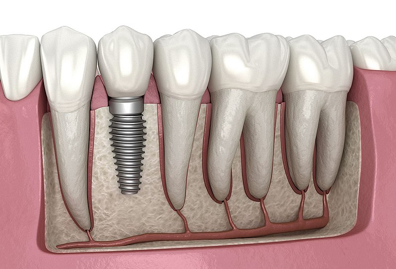 How to Properly Care for Your Dental Implants: Expert Advice