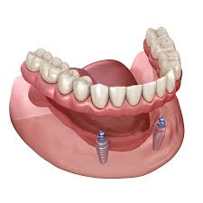 Are Implant Supported Dentures Removable?