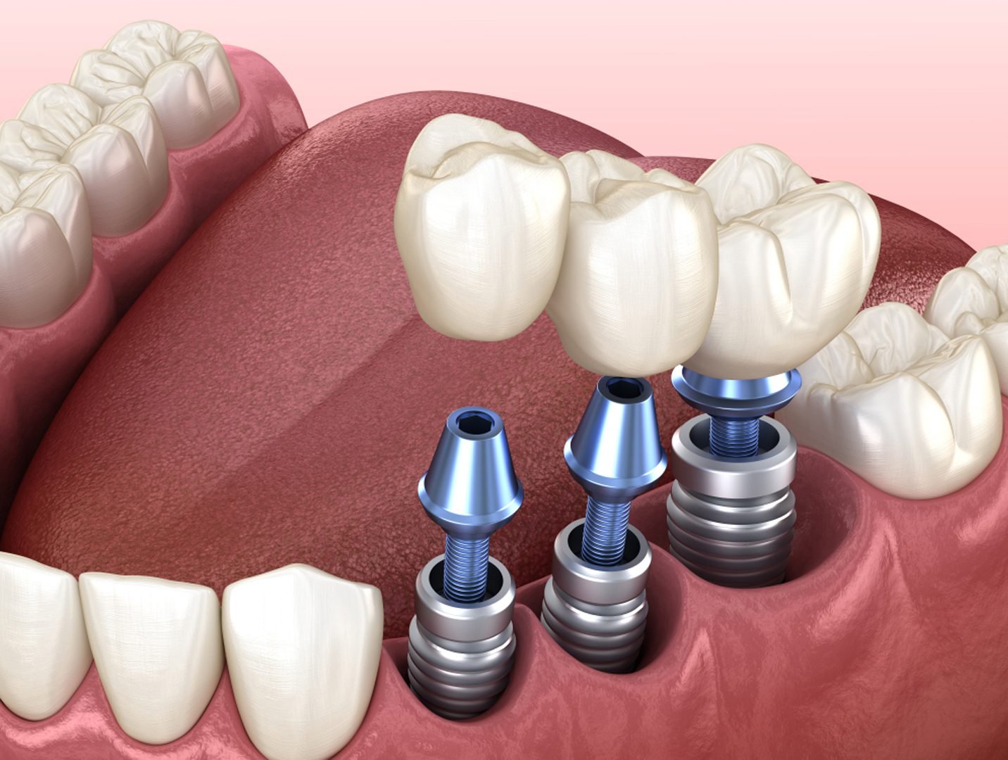 5 Mistakes to Avoid After Dental Implant Surgery