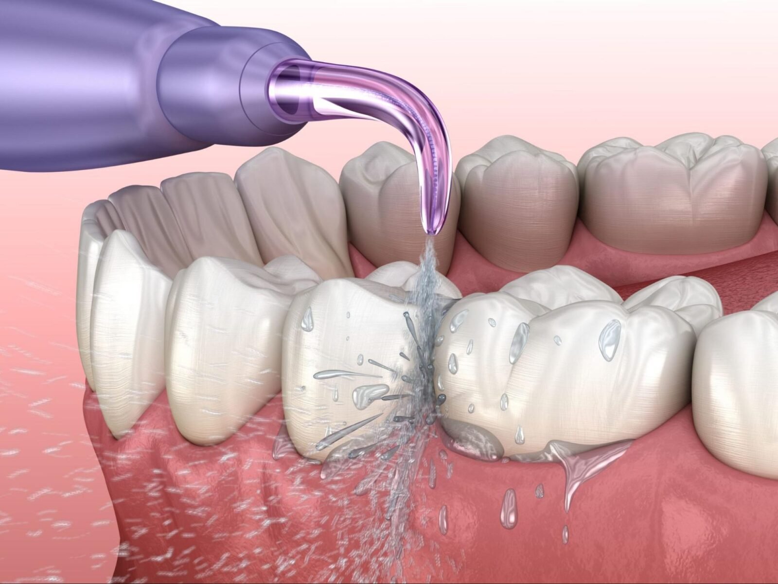 Using an oral irrigator for cleaning