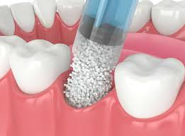 What You Need To Know About A Dental Bone Graft