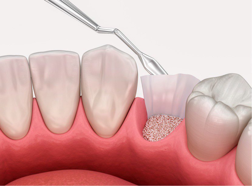 oral or IV sedations