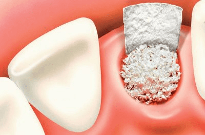 Dental Bone Graft Healing Stages – Topeka Oral Surgery