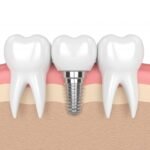 Oral Surgery