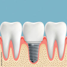 Are Dental Implants Painful After Surgery?