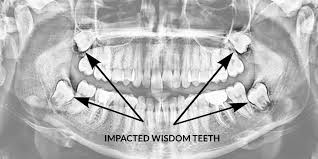 wisdom teeth removal preparation tips from Topeka Oral Surgery