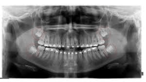 Wisdom teeth removal at Topeka Oral Surgery