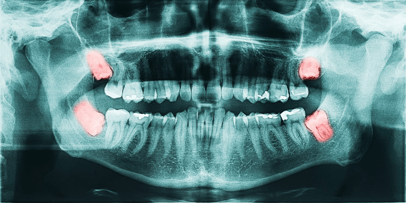 Dry socket after wisdom teeth removal treatment at Topeka Oral Surgery