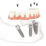 Image of dental implants replacing dentures at Topeka Oral Surgery