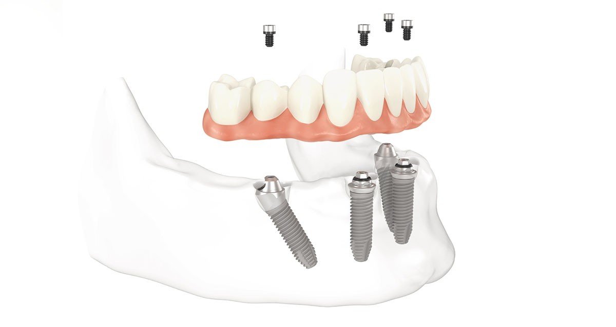 Transitioning from Dentures to Dental Implants