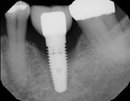  What Happens When a Dental Implant Fails and How to Handle It?