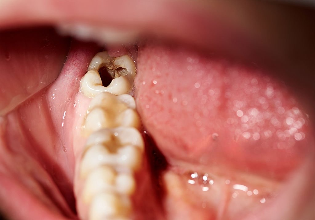 What Happens If You Don’t Remove a Decayed Tooth?