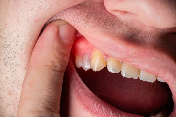 Dental Abscess: Why It’s a Medical Emergency