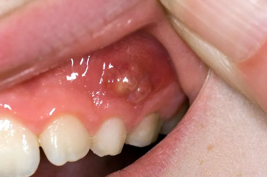 Dental Abscess: Why It’s a Medical Emergency