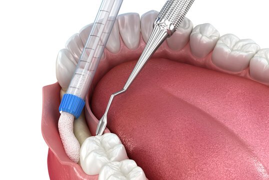 What Is a Dental Bone Graft?