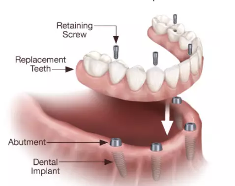 Dental Implants vs. Dentures: Which Is Right for You?