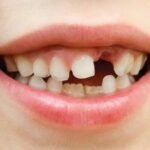 How to save a knocked-out tooth