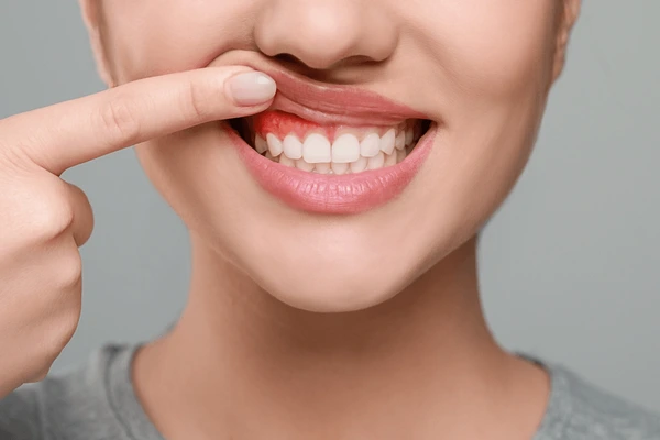 What Is a Dental Abscess?