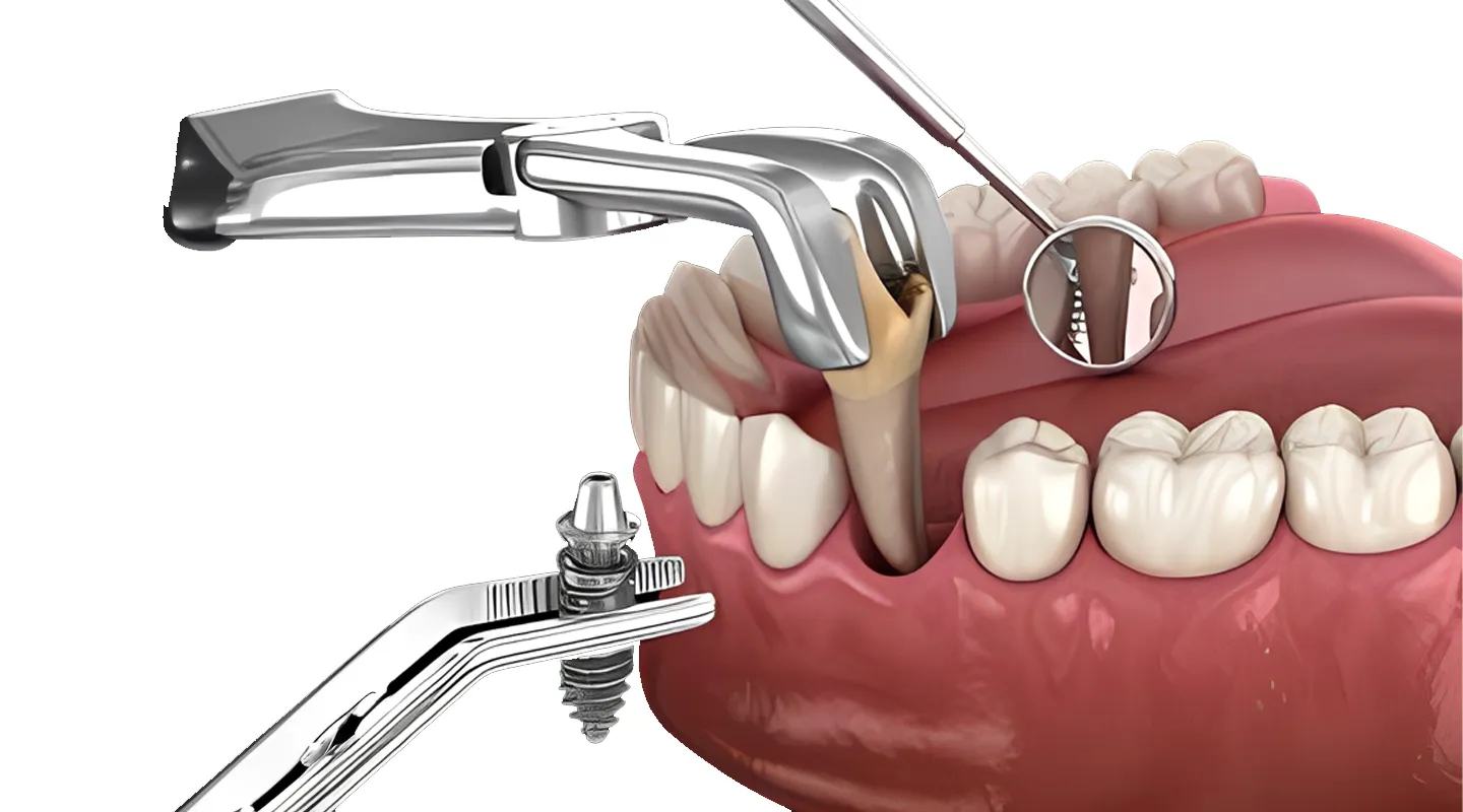 Immediate Dental Implants: A Fast-Track Solution to Replace a Tooth