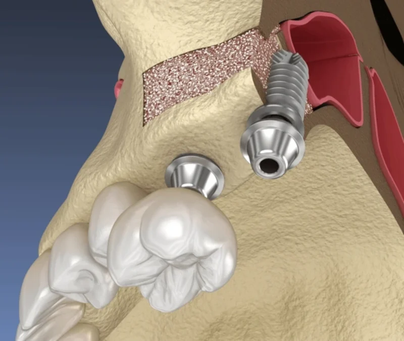 Sinus Lift Bone Grafting: A Comprehensive Guide