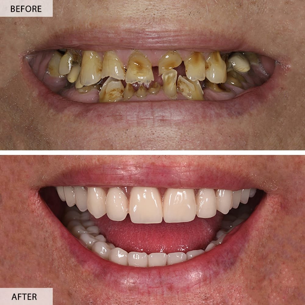 How Dental Implants Boost Your Confidence