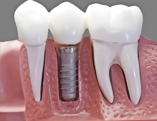 Dental Implants 101: What Are They and How Do They Work?