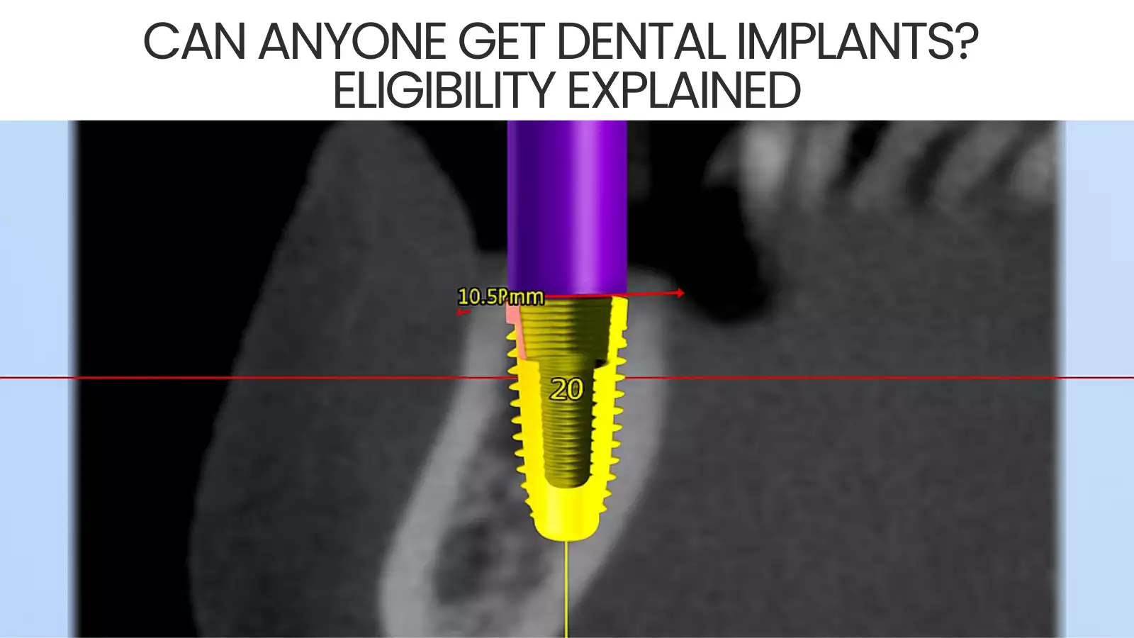 Can Anyone Get Dental Implants? Eligibility Explained