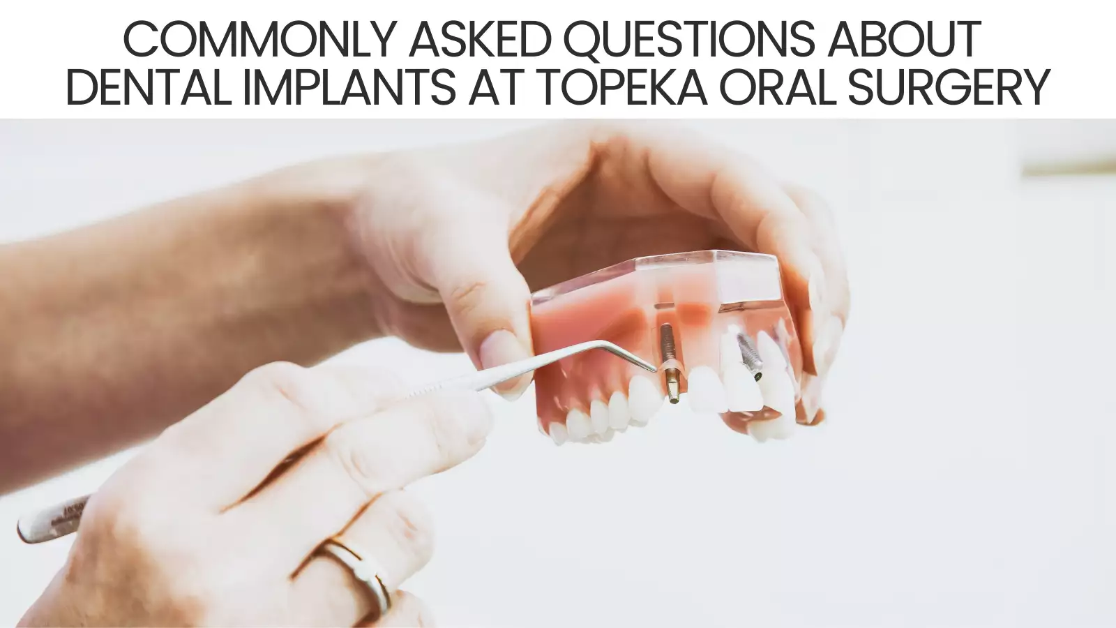 Commonly Asked Questions About Dental Implants at Topeka Oral Surgery