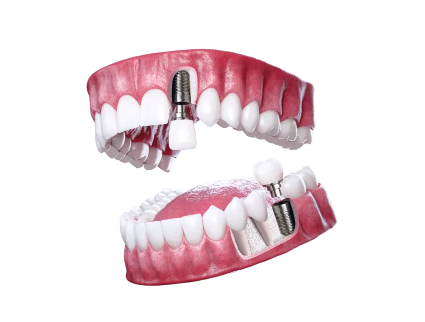 The Ultimate Guide to Dental Implant Surgery at Topeka Oral Surgery ...