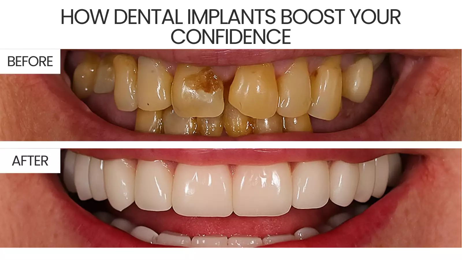 How Dental Implants Boost Your Confidence