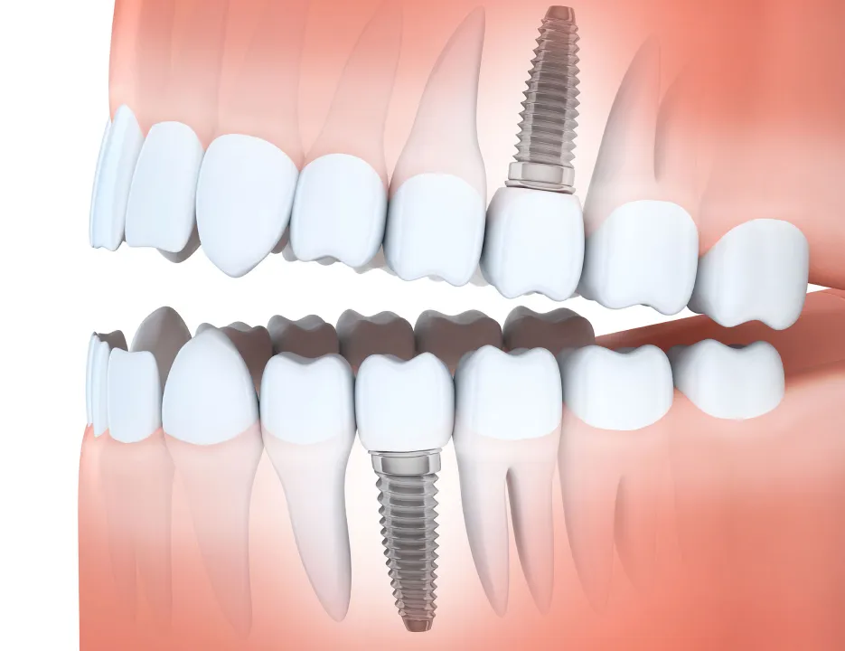 Is Getting a Dental Implant Painful? 