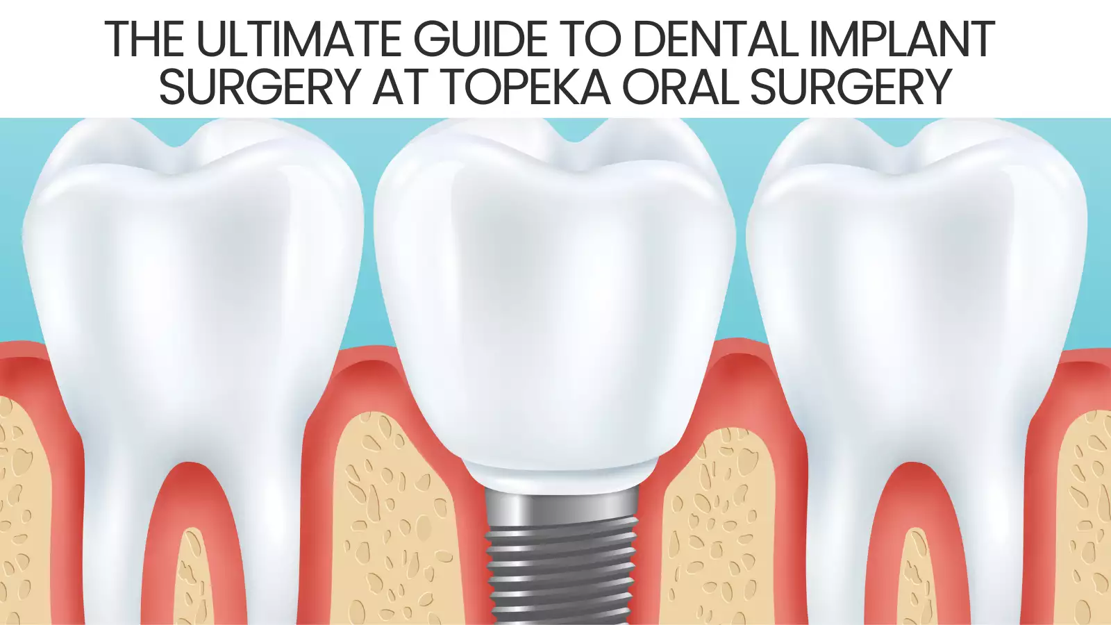 The Ultimate Guide to Dental Implant Surgery at Topeka Oral Surgery