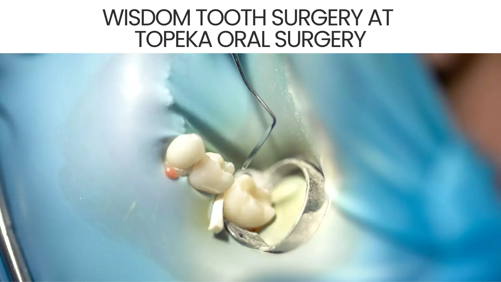 Wisdom Tooth Surgery at Topeka Oral Surgery