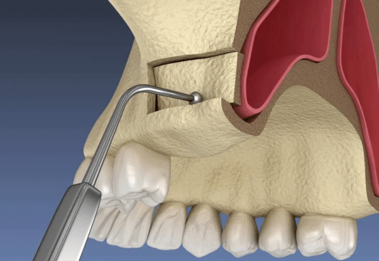 Sinus Lift for Dental Implants at Topeka Oral Surgery