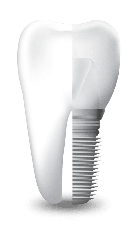 Expert Dental Implants | Topeka Oral Surgery Specialists