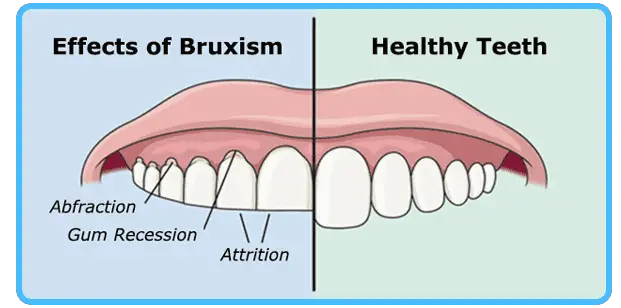 Understanding Bruxism: Causes, Symptoms, and Treatment Options